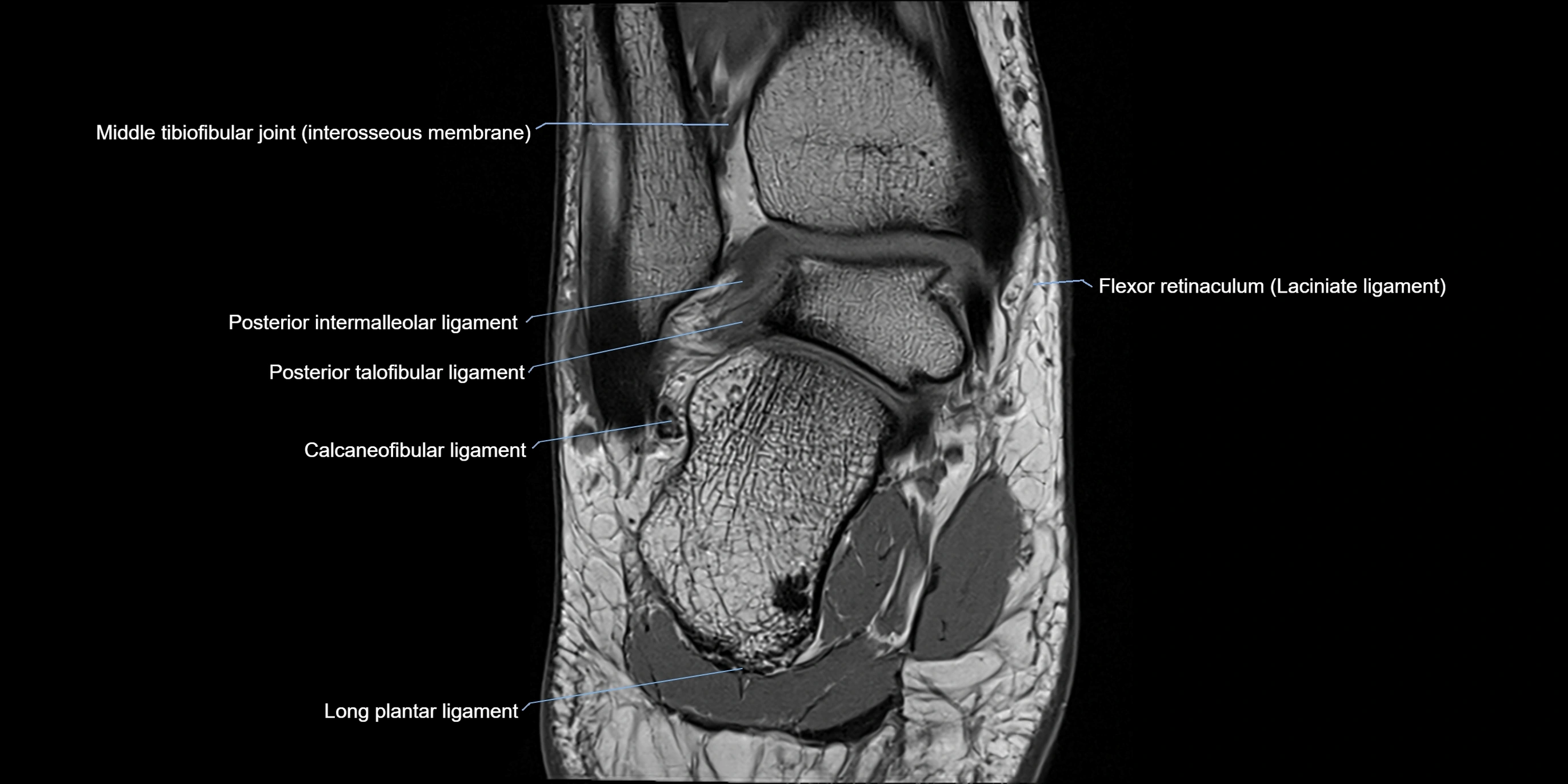 MRI Ankle coronal ligaments cross sectional anatomy 3T  radiology  image-img-00001-00017.webp